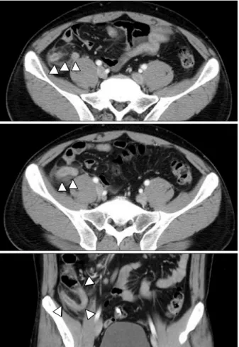 Fig.  1.  Contrast-enhanced  abdominal  CT.  Thickened  and  dilated  appendix  (white  arrowhead)  with  periappendiceal  fluid  collection  was  observed  in  right  lower  quadrant