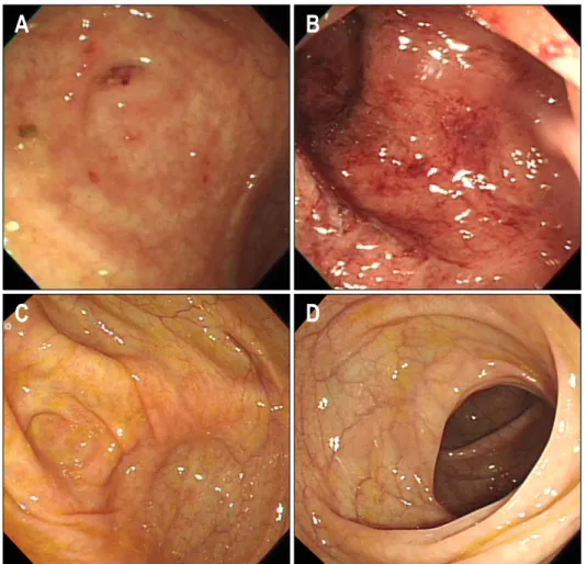 Fig.  2.  Colonoscopic  findings. 