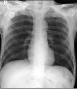 Table 1. Immediate &amp; delayed complications of totally implantable  venous catheter Immediate  complications n=10/100  Malposition 5  (5%) Arterial  puncture 5  (5%) Delayed  complications n=3/100