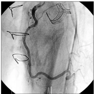 Fig. 2. Diffuse stenotic lesion on the right coronary artery.