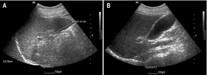 Fig.  1.  Initial  abdominal  ultrasonographic  findings  showed  the  increased  length  of  splenic  long  axis  (about  13.7  cm)  (A),  but  did  not  re- re-veal  definite  abnormal  hepatic  image  (B).