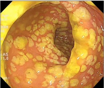Fig.  2.  Sigmoidoscopic  finding.  There  were  diffusely  scattered  numerous  elevated  yellowish  plaques  with  edematous  and   hypere-mic  mucosa.