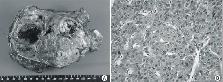 Fig. 3. Gross finding shows a globular tumor mass embeded with segment of rib weighing 650 gm and measuring 14×10×7.5 cm in  dimensions  (A)