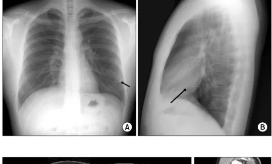 Fig. 2. Chest computed tomography  showed a foreign body suspected of  being a metal artifact