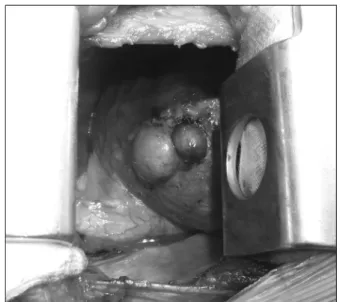 Fig. 3. Upon surgical finding, two round masses are noted and  they look like liver tissues.