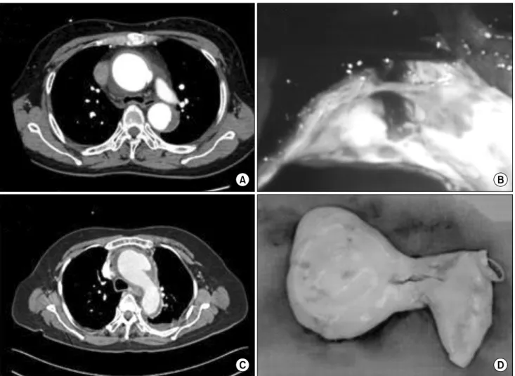 Fig. 1. CT images and Intraoperative findings of intimal defects: ulcer-like projection (A &amp; B) and short linear tear (C &amp; D)