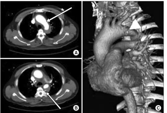 Fig. 3. Preoperative CT images of  Patient 36. Apparently, there is not  a definitive finding suggestive of  in-timal defect except for a focal  irreg-ularity in the aortic wall (A, arrow)