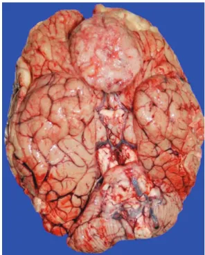 Fig. 2. A large meningioma is seen at the base of the frontal lobe. Also present is an anteriorly displacement of medulla with wrap by cerebellar tonsils.