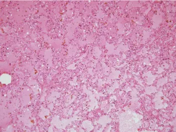 Fig. 4. Microscopic view of the lung shows severe edema in alveoli (H &amp; E, × 100).