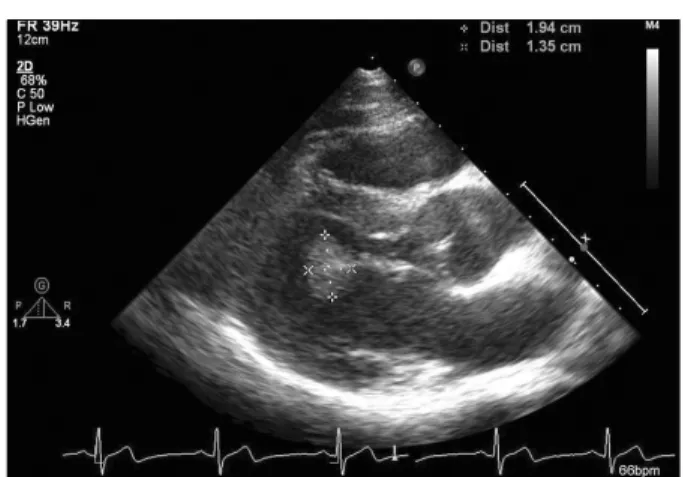 Fig. 1. Preoperative transthoracic echocardiogram shows round  and movable mass (2×1 cm) which was attached to chordae and  anterolateral papillary muscle