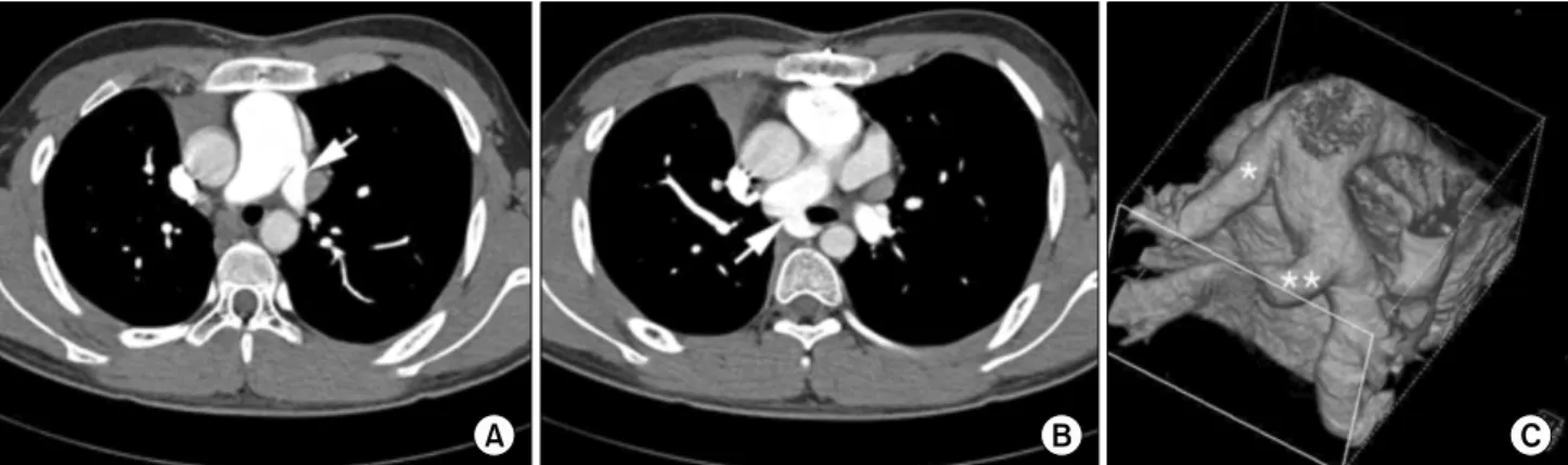 Fig. 5. Postoperative chest computed tomography. (A) Reimplanted left upper pulmonary artery originate from main pulmonary artery