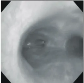 Fig. 2. Chest CT scan shows a bridging bronchus arising from left main bronchus with distal atelectasis.