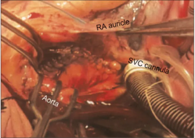 Fig. 2. The view of repaired incision.
