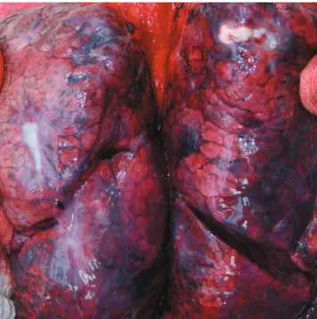 Fig.  1. Small bilateral nodules which measured more than 1.0 cm are noted in pleural surface of the upper lobes.