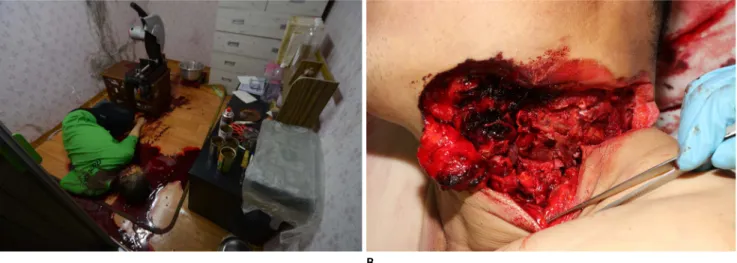 Fig. 2. (A) The victim was found lying dead in a pool of blood near a small table on which an abrasive saw had been fixed