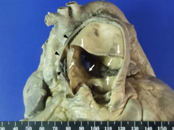 Fig. 2. The right pulmonary artery shows fatty streaks and atheromas  on the intimal surface along its branches.