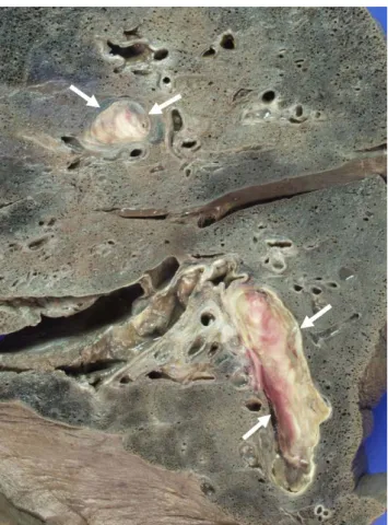 Fig. 3. The lung parenchyma shows two organizing thrombi (arrows)  in the branches of the pulmonary artery