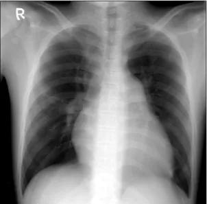 Fig. 3. Left pulmonary arteriotomy is extended to the left pleural.
