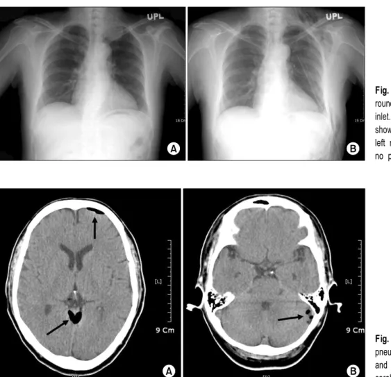 Fig. 1. (A) Preoperative X-ray shows  round mass shadow at left thoracic  inlet. (B) Postoperative X-ray (POD#3) shows subcutaneous emphysema at  left neck and tube insertion site, but no pneumothorax.