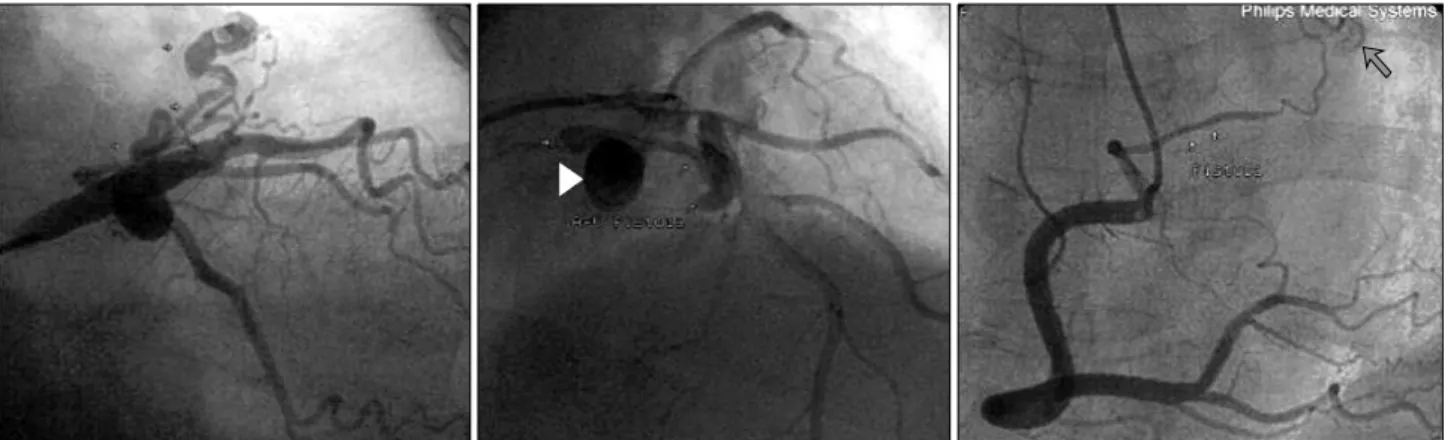 Fig. 2. Chest computed tomography demonstrates the origin of the left coronary-to-pulmonary artery fistula from the left anterior descending cor- cor-onary artery (A, arrow) and a saccular aneurysm located behind the main pulmcor-onary artery (B, arrow hea