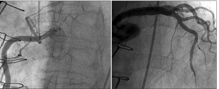Fig. 3. Postoperative coronary angiography demonstrates the disappearance of bilateral coronary to pulmonary artery fistulae with a saccular aneurysm