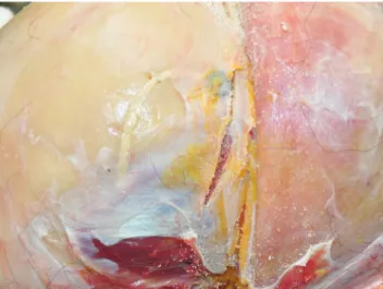 Fig. 2. The diffuse subdural hemorrhage in the right hemisphere  measured approximately 100 mL.