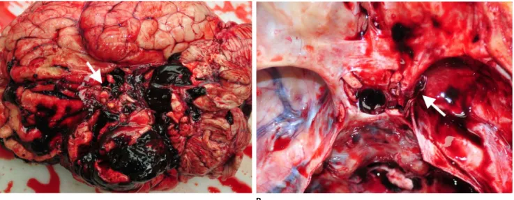 Fig. 4. Two aneurysmal clips. (A) The diffuse subarachnoid hemorrhage on the right side at the base of the brain and an aneurysmal clip (arrow)  in the anterior communicating artery