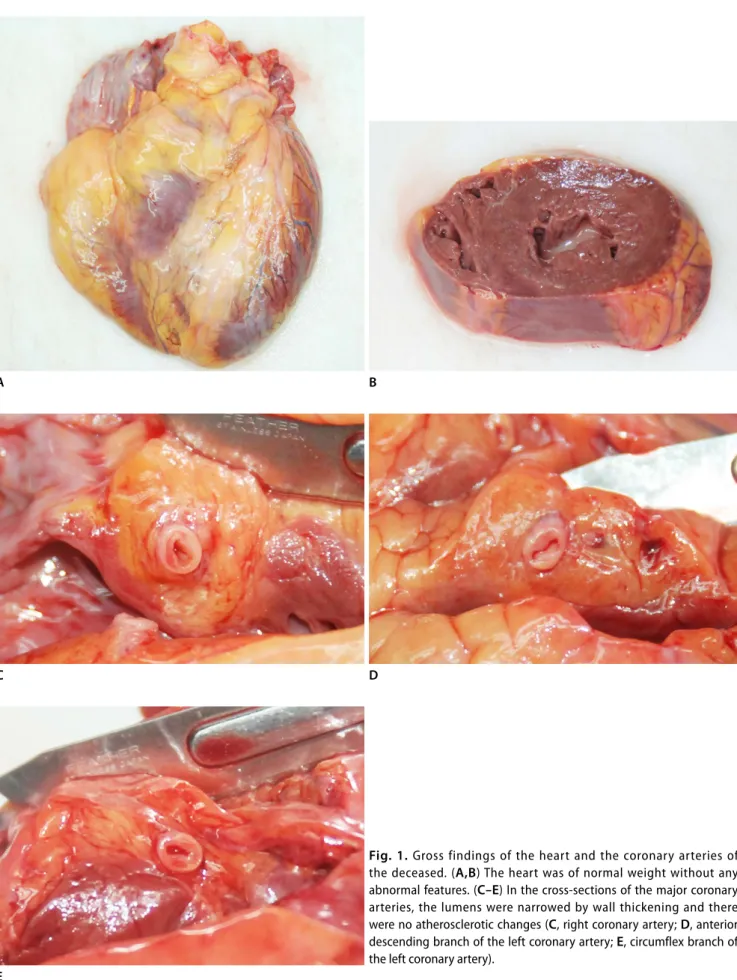 Fig. 1. Gross findings of the heart and the coronary arteries of  the deceased. (A,B) The heart was of normal weight without any  abnormal features