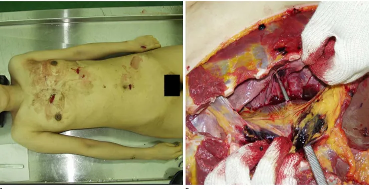 Fig. 2. (A) Stab wounds on the victim’s torso. The stab on the left hand is the same as that in the lower abdomen
