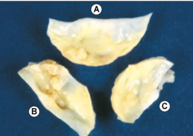 Fig. 3. Verrucose lesion of the aortic valve with fibrosis, hyaline  change, and focal calcification (Hematoxylin and eosin stain; × 40).