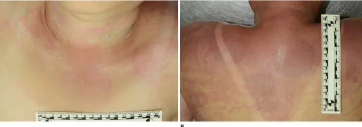 Fig. 1. Multiple rectangular or circular intradermal hemorrhages were observed in the neck and chest (A), back (B), and waist (case 1).