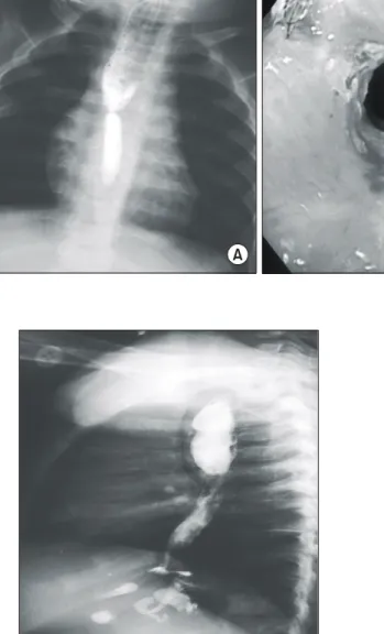 Fig. 2. Preoperative esophagogram shows severe segmental  narrowing in intrathoracic anastomosis site with proximal  barium stasis