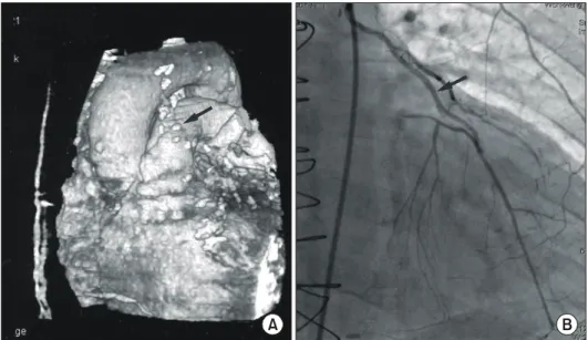 Fig. 3.  In  CT  angiography, the internal thoracic artery  graft  (long black arrow) was not visible and the radial artery  graft  (black  arrow head) that was y-grafted to the internal thoracic artery was not also seen (A)