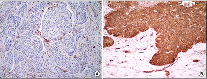 Fig. 1. Typical results of fascin immunohistochemical staining. (A) fascin negative: In normal esophageal epithelium, fascin in invariably ex- ex-pressed in endothelial cells of microvessels as well as the stromal cells of the interstitium (×100)