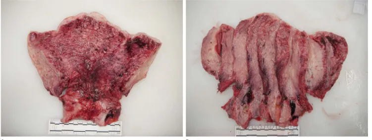 Fig. 2. (A, B) Uterus showed no specific abnormality, such as retained placenta or perforation.