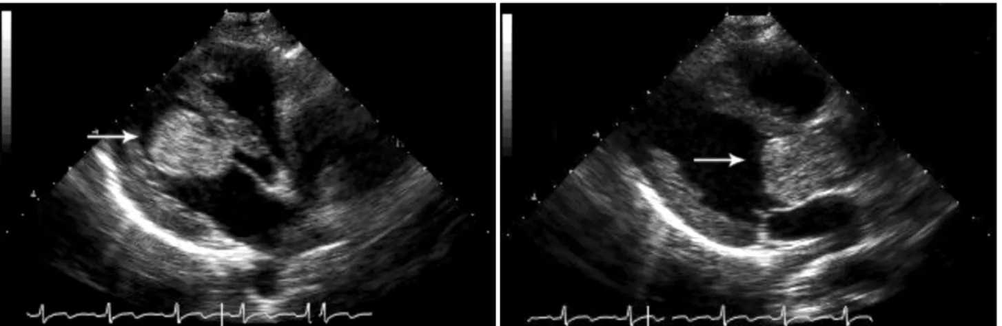 Fig. 1. Preoperative 2-D echocardiogram shows 4×3 cm sized mass in the left ventricle (white arrows) causing left ventricular outflow  obstruction.