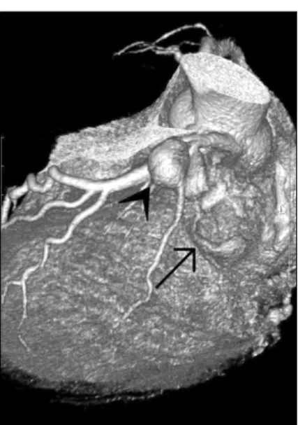 Fig. 3. (A) Intraoperative picture showing one aneurysm in proximal part of ramus intermedius with a clear margin (arrow head) and the  other large aneurysm in proximal part of left circumflex artery with a vague one (arrow)