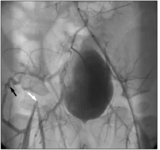 Fig. 3. Angiography was followed after bypass graft. Obstruction  of graft was observed (white arrow) and collaterals was well  de-veloped (black arrow).