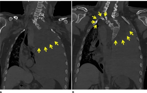 Fig. 1. External and internal autopsy findings consistent with neurofibromatosis. (A) Numerous cutaneous neurofibromas and hyperpigmented  macules were noticed in the patient’s body