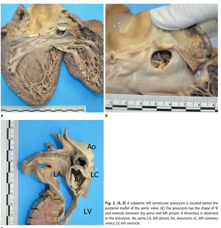Fig. 2. (A, B) A subaortic left ventricular aneurysm is located below the  posterior leaflet of the aortic valve