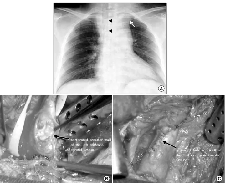 Fig. 2. Initial chest X-ray (A) showed widening of superior mediastinum (arrow), subcutaneous emphysema, and tracheal deviation to the right side (arrow head)