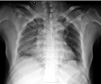 Fig. 3. Post-operation 37days follow-up Chest X-ray.