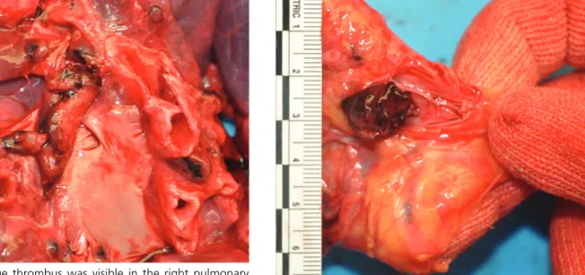 Fig. 1. A large thrombus was visible in the right pulmonary