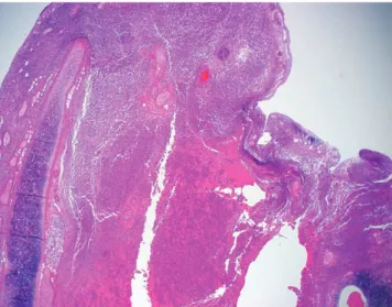Fig. 2. Microscopic finding of epiglottitis and epiglottic abscess, with dense infiltration of neutrophils and necrotic material in mucosal and submucosal tissues (H&amp;E, ×20).