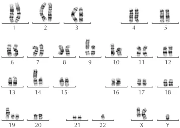 Fig. 3. Chromosome analysis showing complex karyotype  of 47,XY,+del(X)(q24),?del(6)(q13q21),add(9)(p24),add(14)  (p10),+19,der(19)t(1;19)(q24;p13.3),-22[cp6]/46,XY[14].1234567891011 1213141516171819202122XY