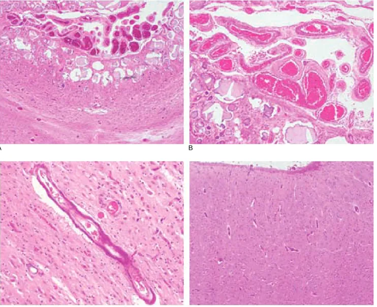 Fig. 2. Brain cortex shows severe dystrophic microcalcification combined with leptomeningial angiomatosis (A) which includes thick- thick-ened vascular wall due to hyalinization (B)