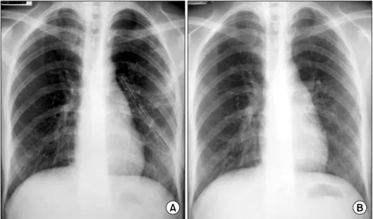 Fig. 2. Initial CT (A) shows extensive consolidation, peripheral micronodularity and tiny multiple cystic changes
