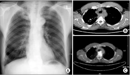 Fig. 1. Initial chest PA (A) shows  right paratracheal mass with mild  tracheal deviation