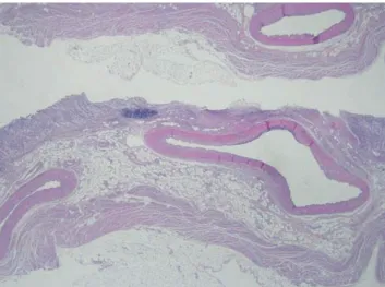 Fig. 2. Microscopic examination showed the large and tortuous submucosal arteries and the mucosal erosion.