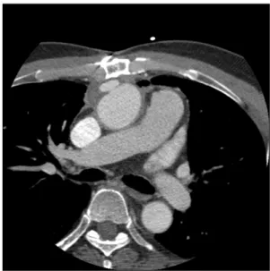 Fig. 2. The Pruitt’s aortic occlusion catheter.